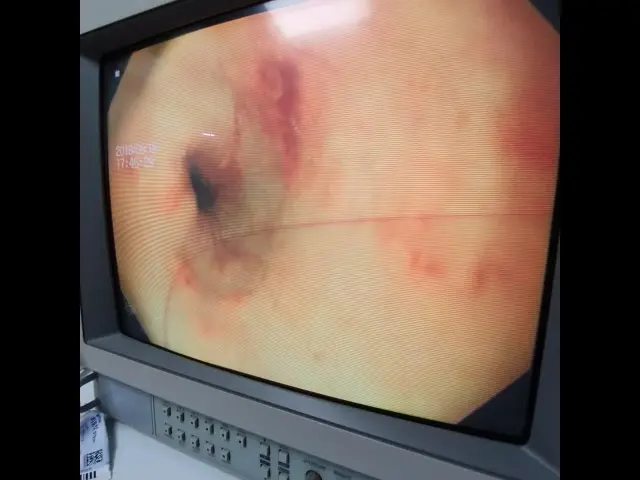 6살 강아지 식도이물 내시경처치