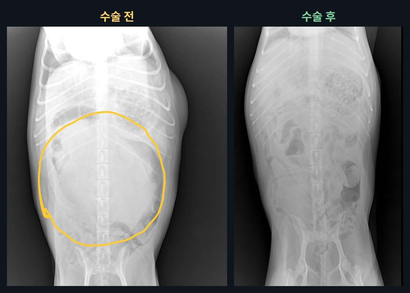 복배상 촬영 비교. 종괴에 밀려 보이지 않던 장기 윤곽과 장 가스 무늬가 수술 후 다시 보입니다.