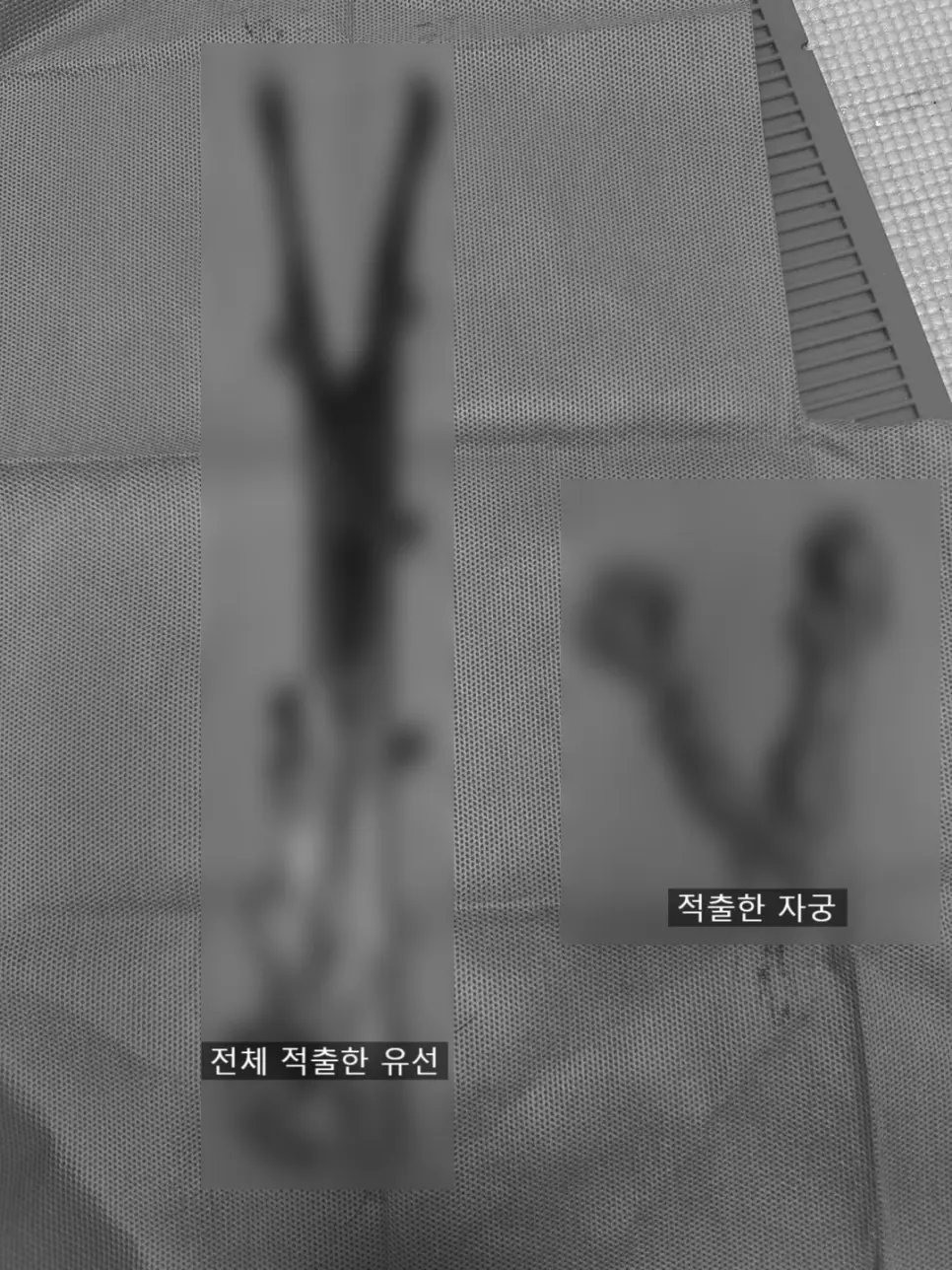 적출한 유선과 자궁