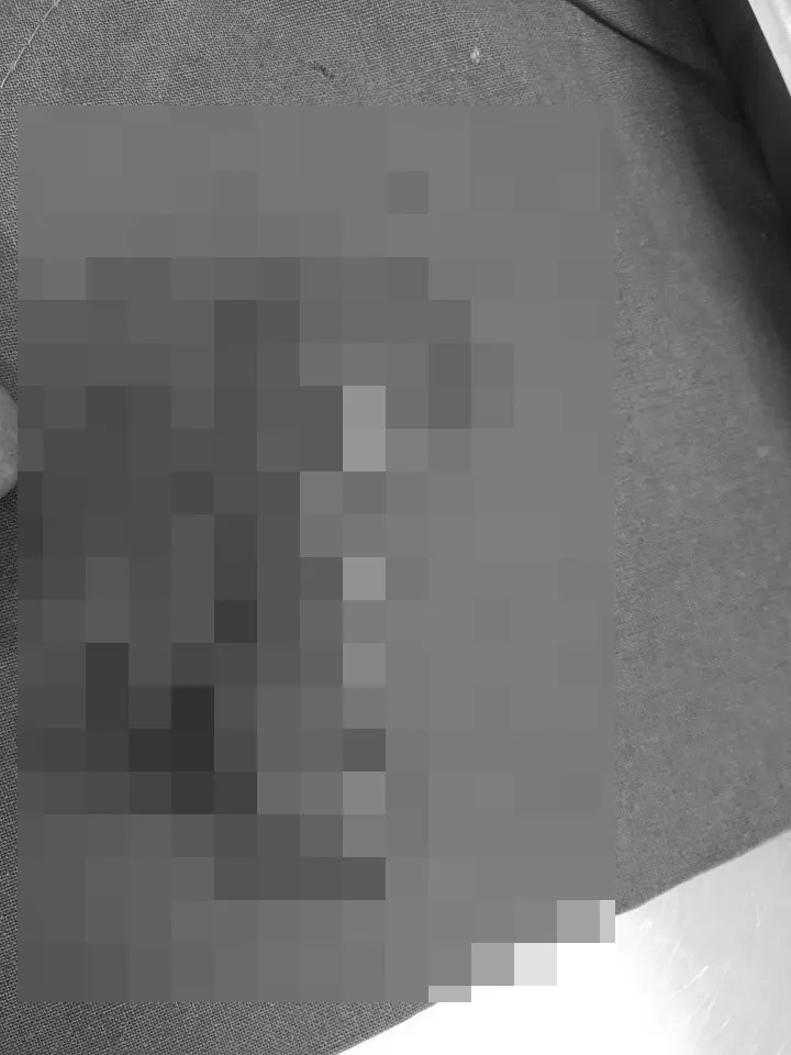 말티즈 유선종양 수술 사례 이야기